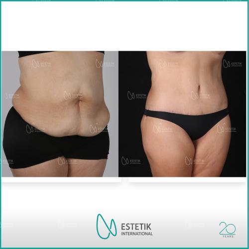 Liposucción Láser Foto antes/después